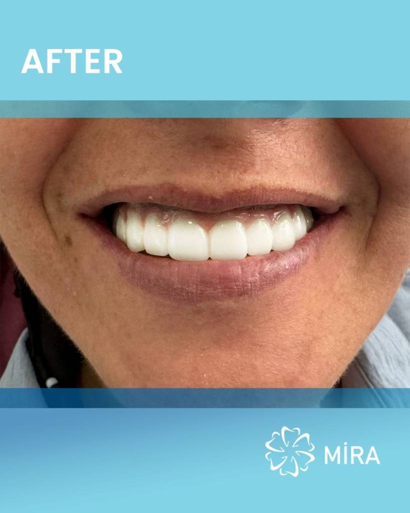 all-on-four-mira-after
