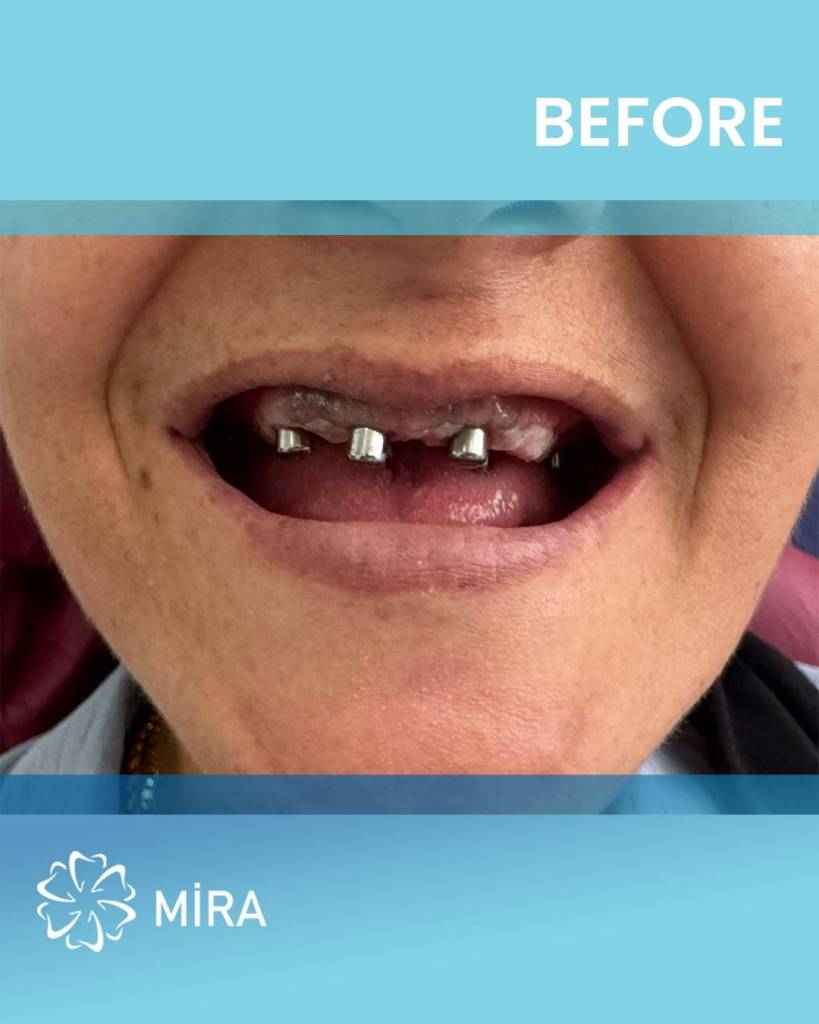 all-on-four-mira-before