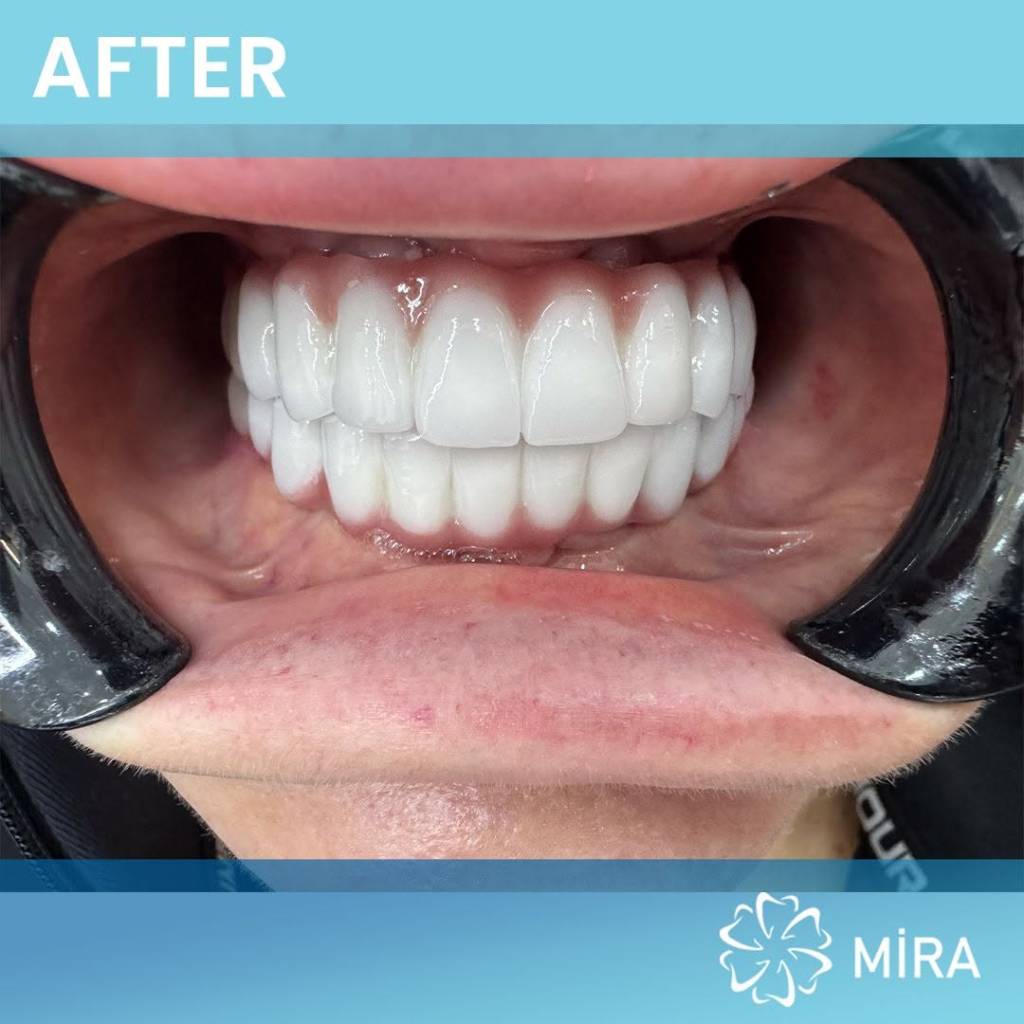 all-on-four-miradental-after-1