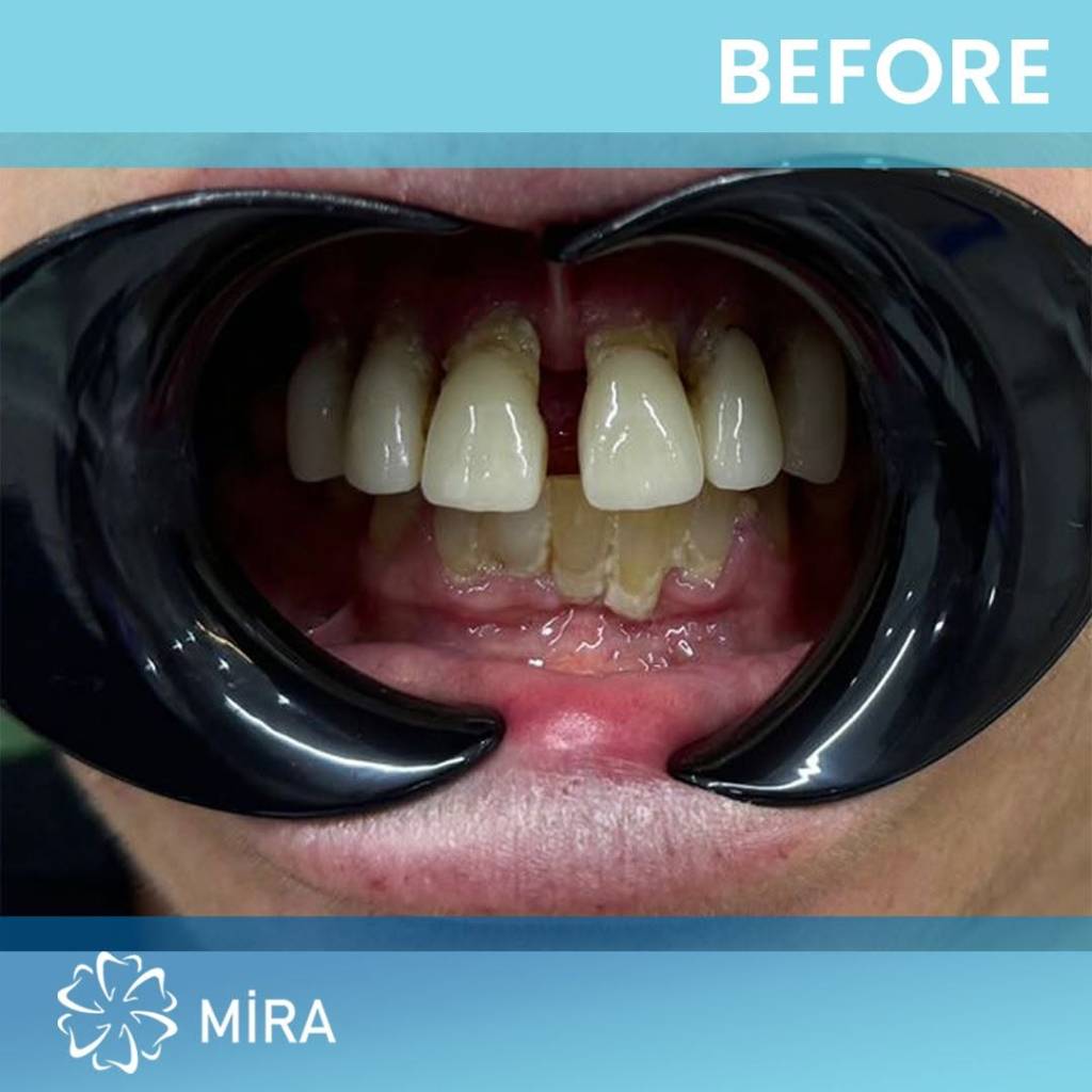 all-on-four-miradental-before-1