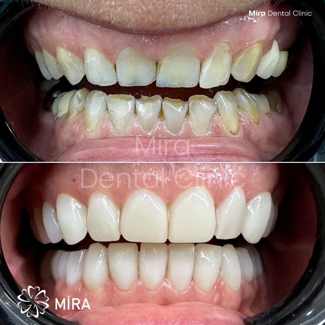 dental-veneer-turkey-antalya