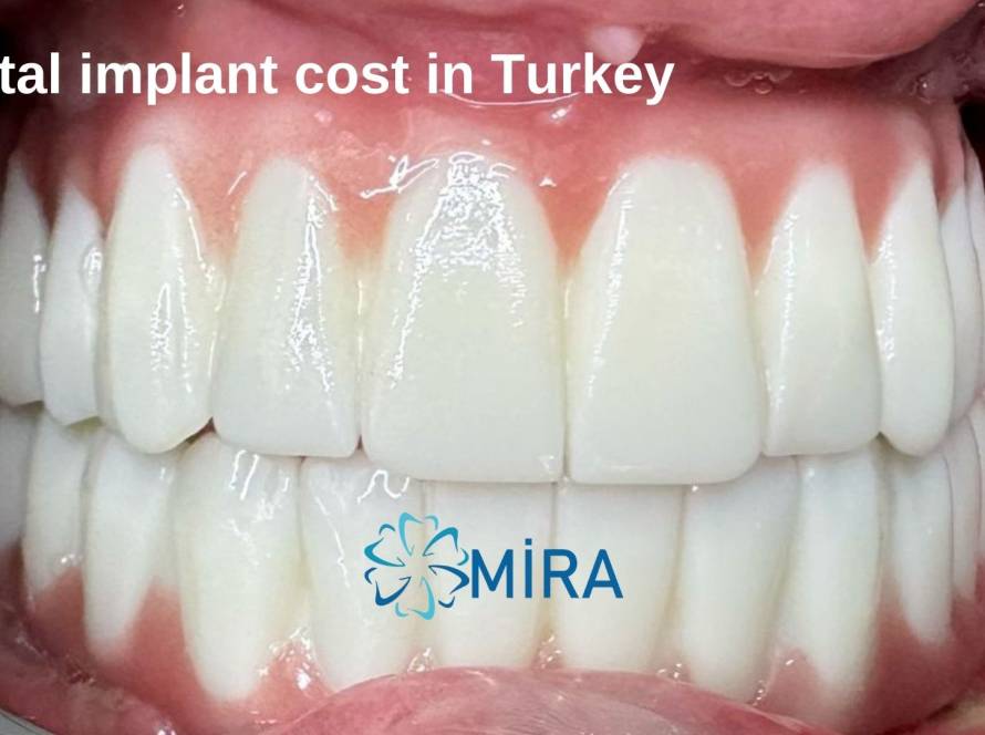 dental-implant-cost-in-turkey (2)