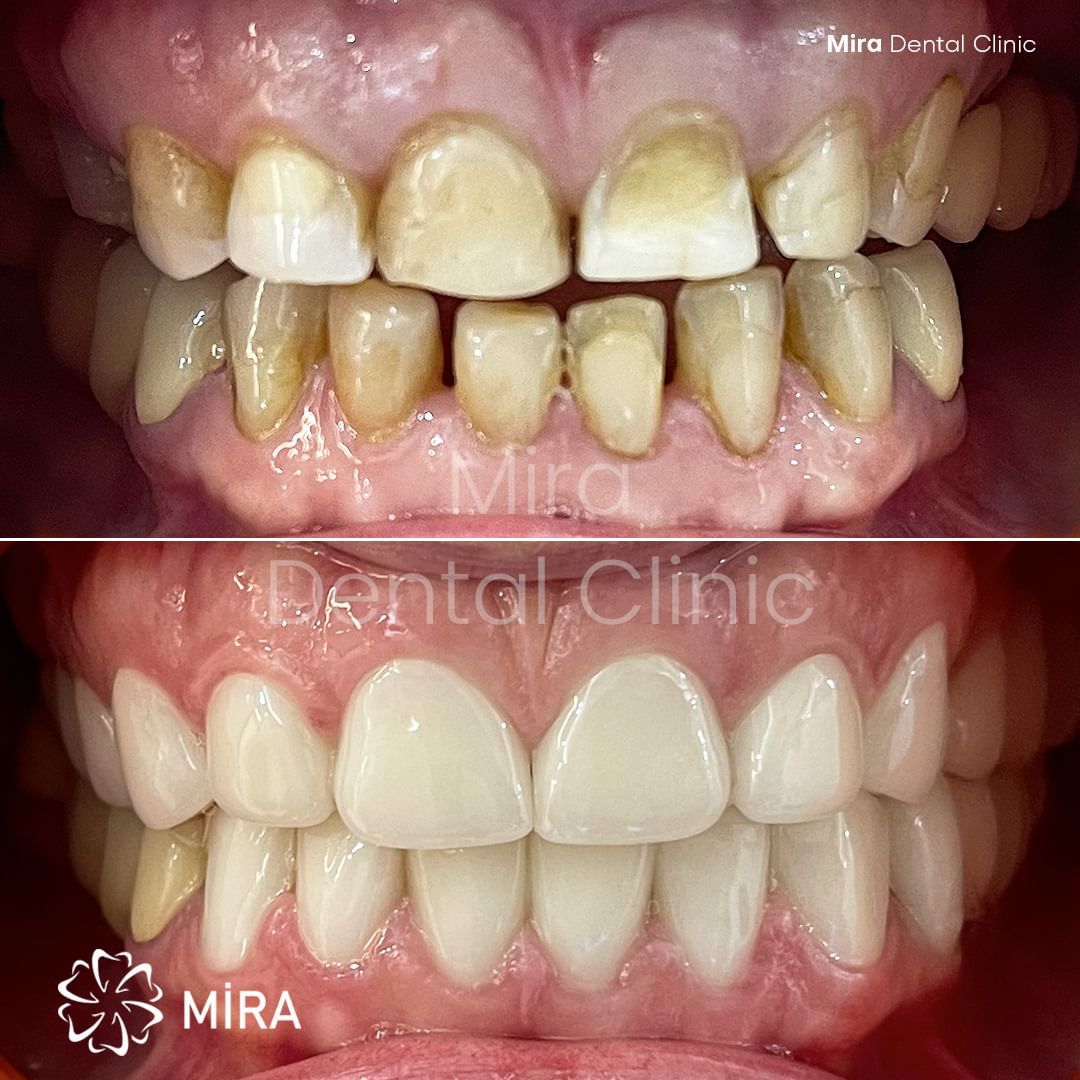 dental-implants-turkey-antalya