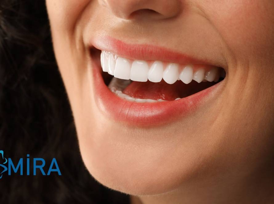dental-veneers-turkey-antalya