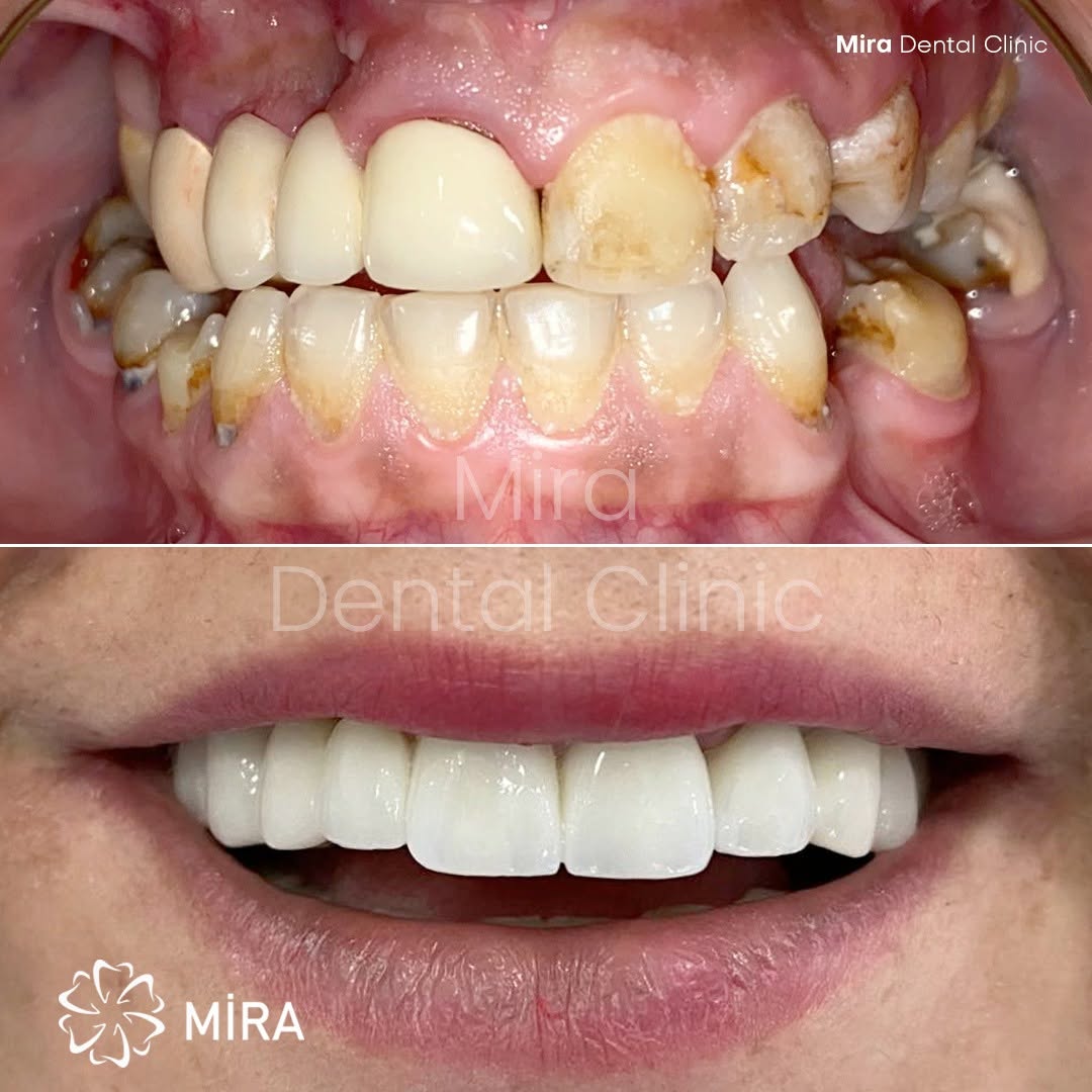 emax crown in turkey, antalya