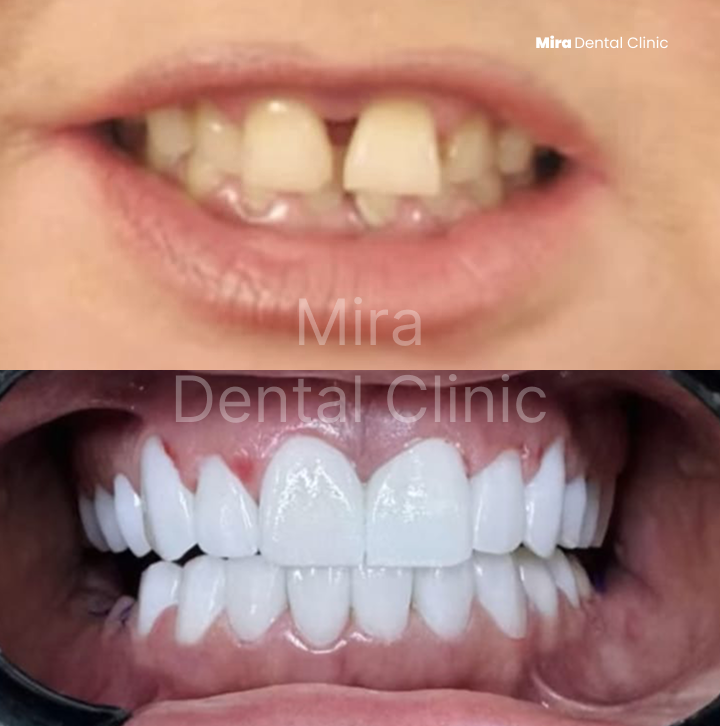before-after-miradental-1