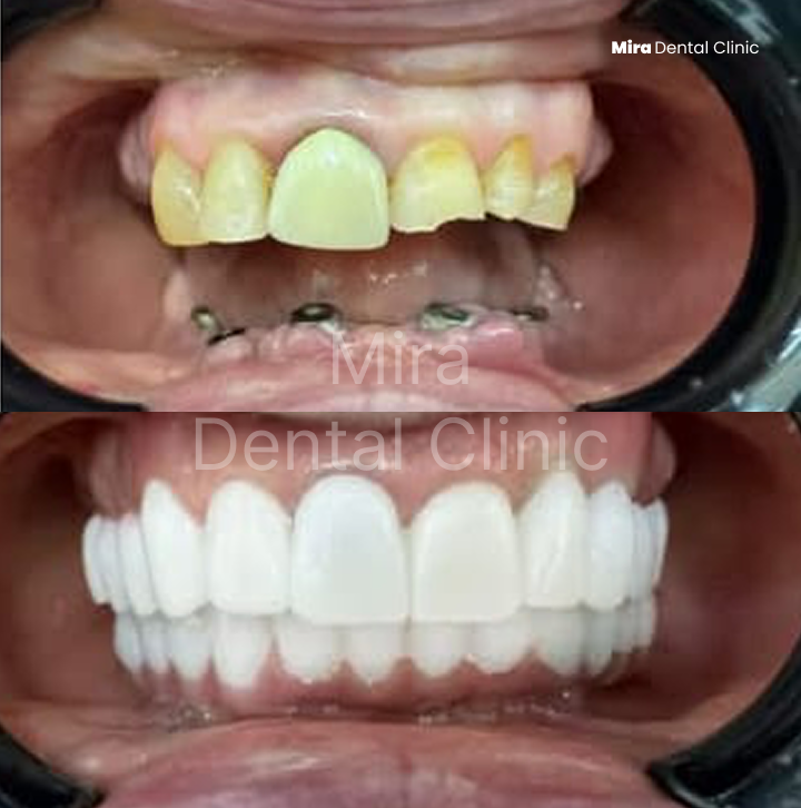 before-after-miradental-2